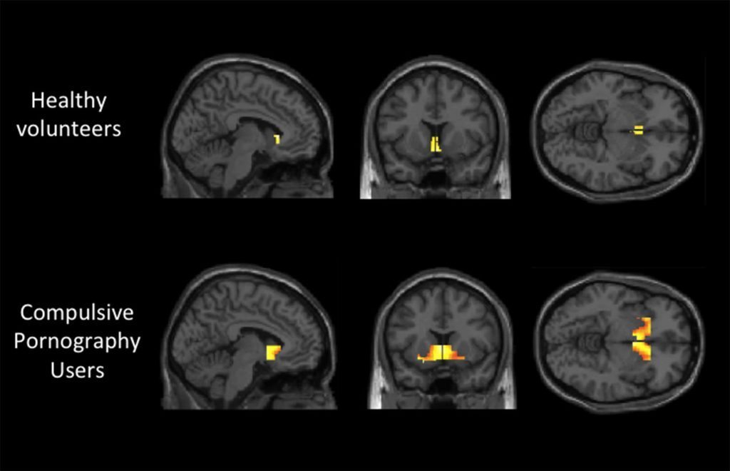 porn-addiction-brain-scan